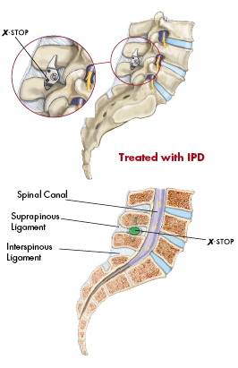 Treated with X Sotp